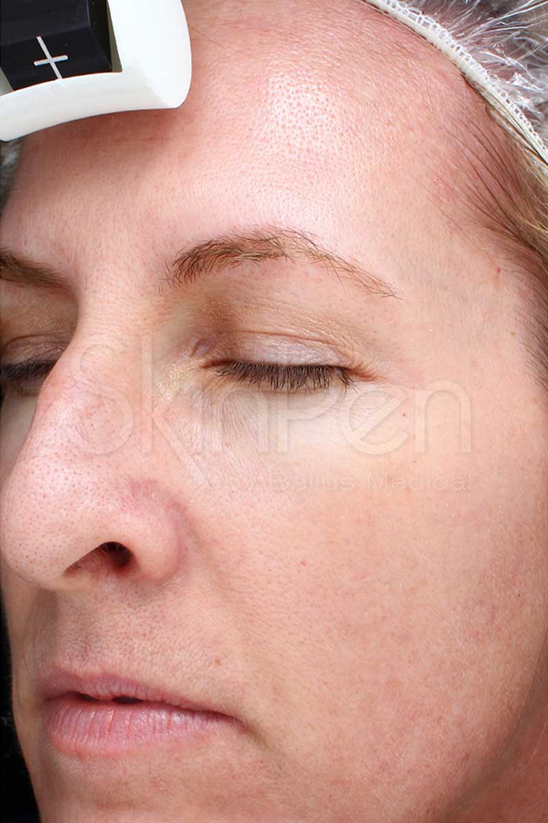 SkinPen Microneedling - After Image