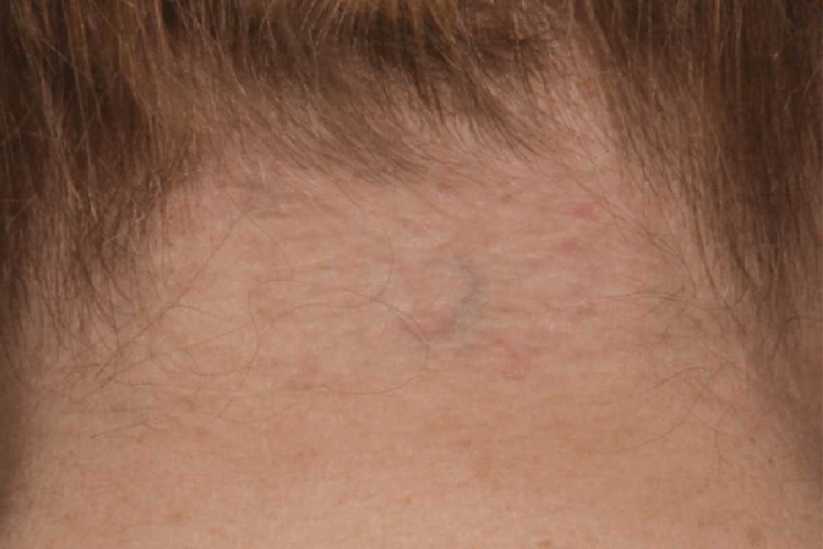Tattoo Removal - After Image