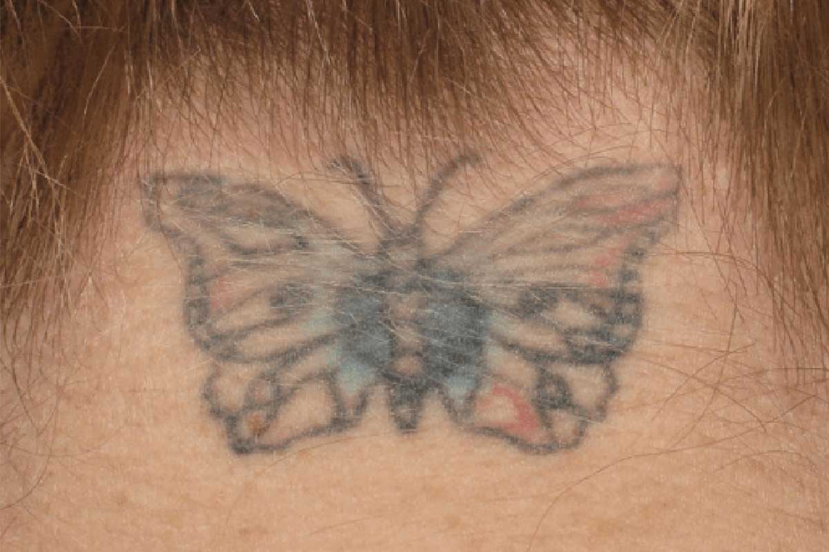 Tattoo Removal - Before Image